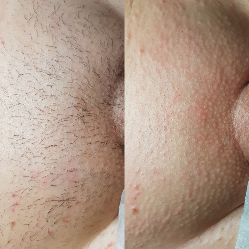 Депиляция интимной зоны мужская