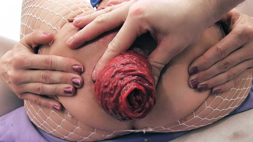 Светлана Корлякова anal prolapse